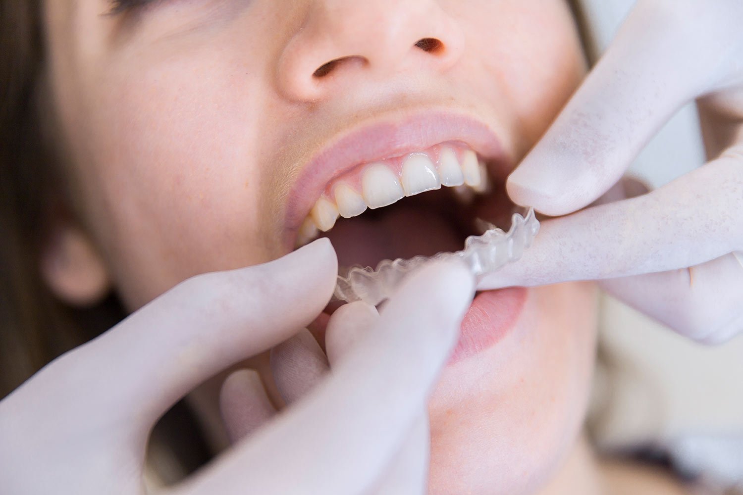 Invisalign-dentista