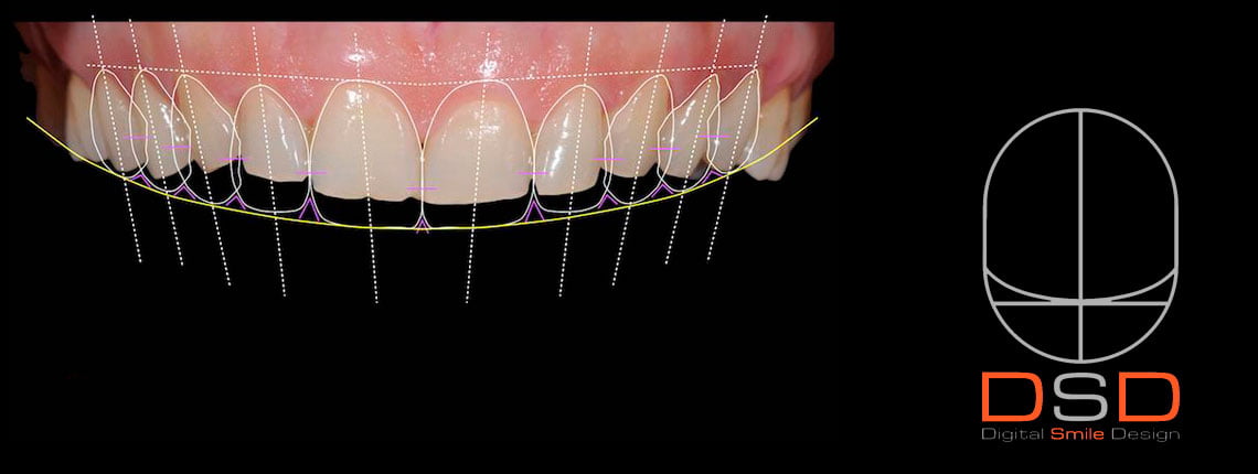 slide-dsd-1