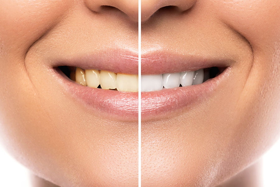 tratamiento de blanqueamiento dental