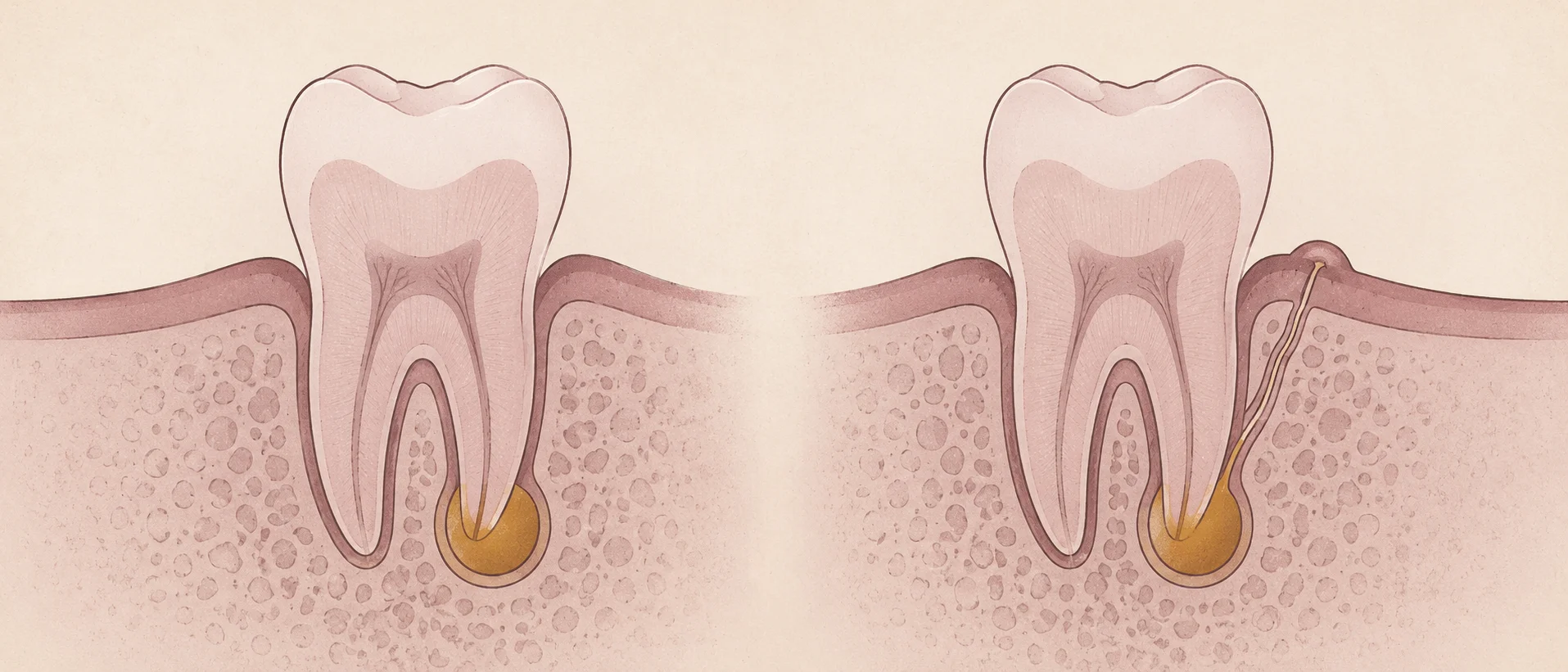 Diferencia entre absceso dental y fístula con salida en la encía o parúlide