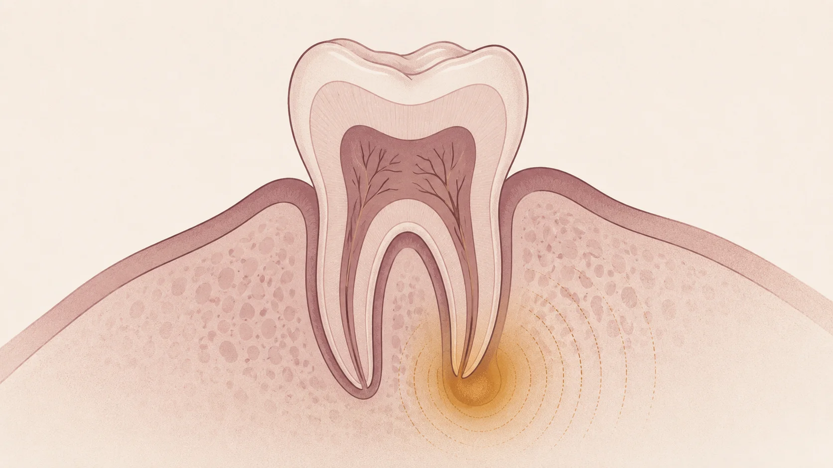 Sección de un molar con absceso periapical, origen del flemón dental