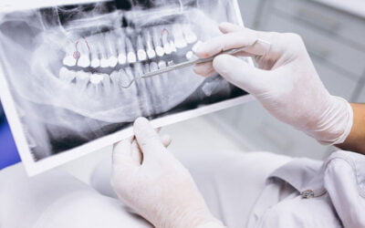 Te lo contamos todo sobre la pérdida de hueso dental