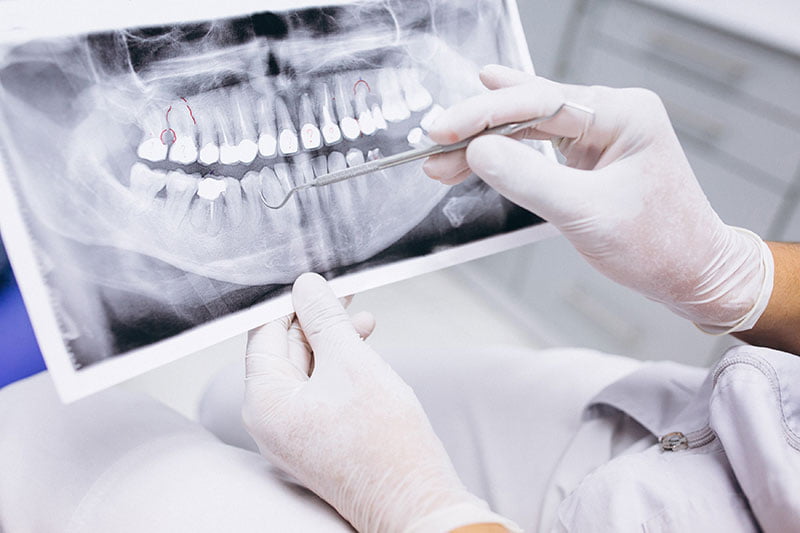 problemas de hueso dental | Clínica Dental Parque