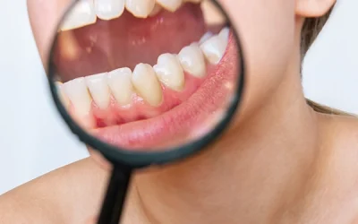 El problema del sarro en los dientes