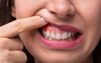 ¿Necesitas una gingivectomía?
