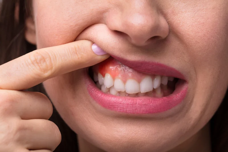 ¿Necesitas una gingivectomía?