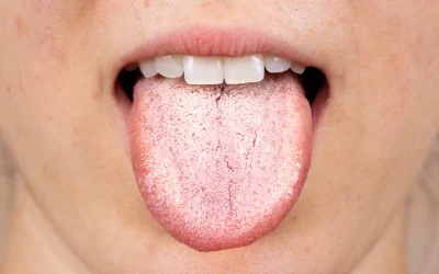 ¡Tengo hongos en la lengua!