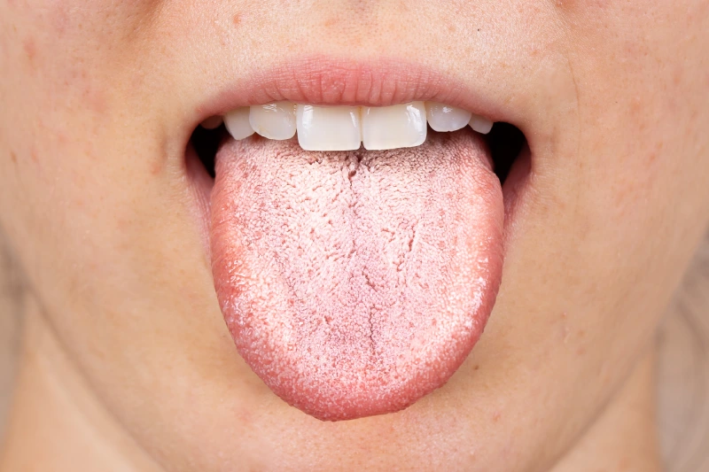 ¡Tengo hongos en la lengua!