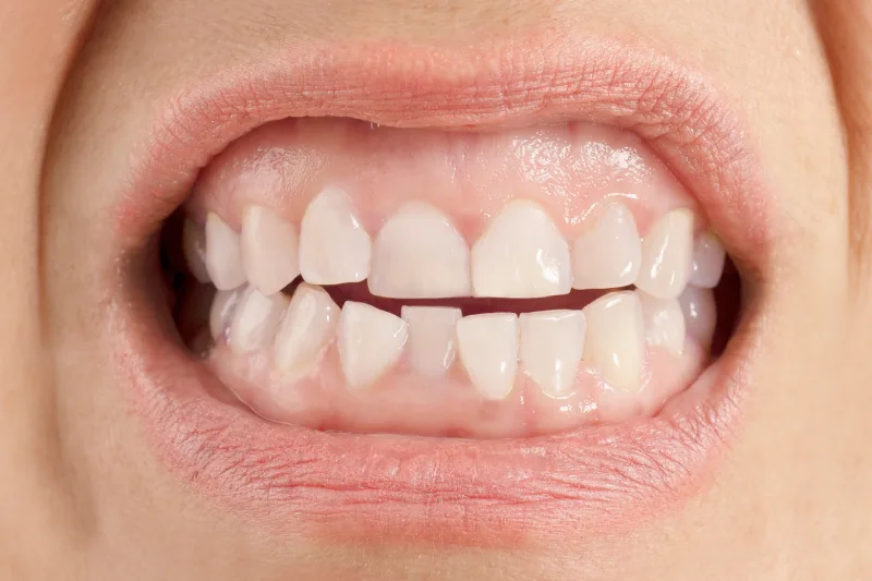 caracteristicas sonrisa gingival