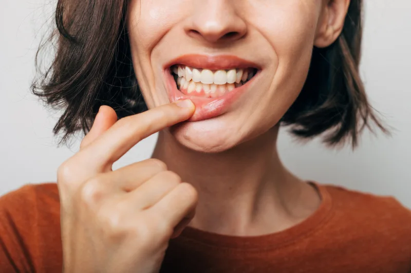 ¿Demasiada encía al sonreír? La sonrisa gingival