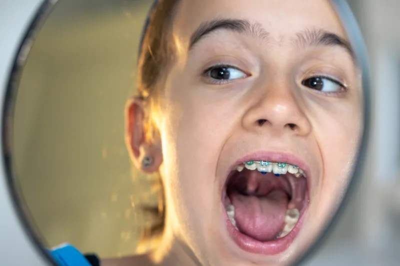 niña con aparato de dientes