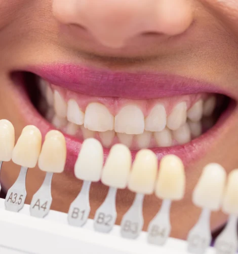 carillas para dientes